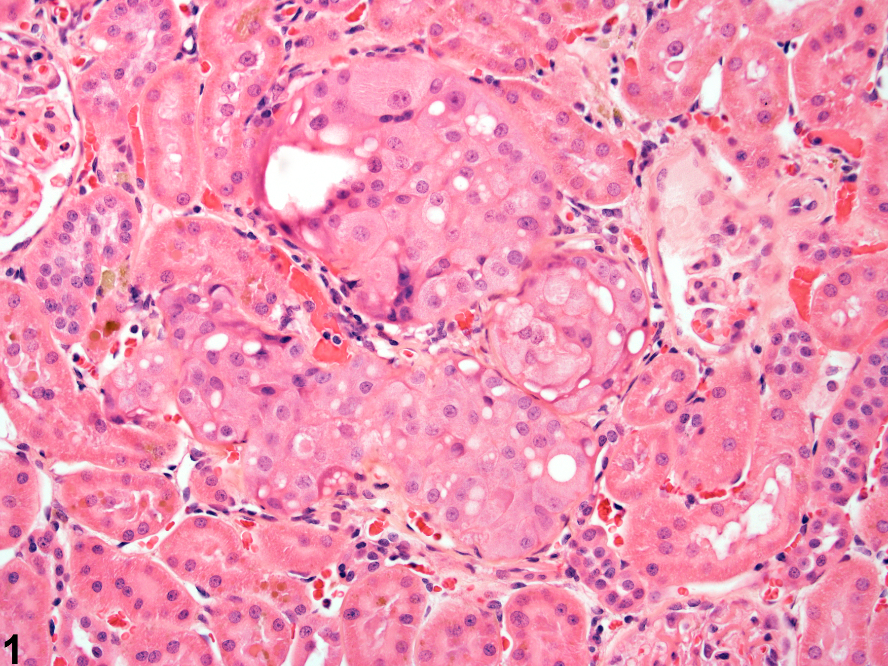 Image of renal tubule hyperplasia, amphophilic-vacuolar in the kidney from a female F344/N rat in a chronic study