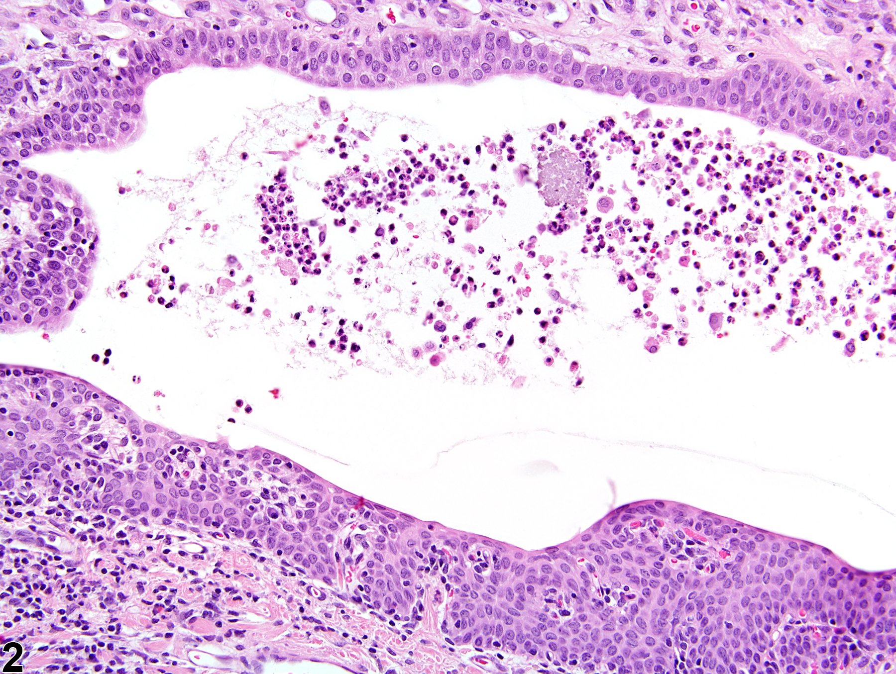 Image of urothelium hyperplasia in the kidney from a female F344/N rat in a chronic study