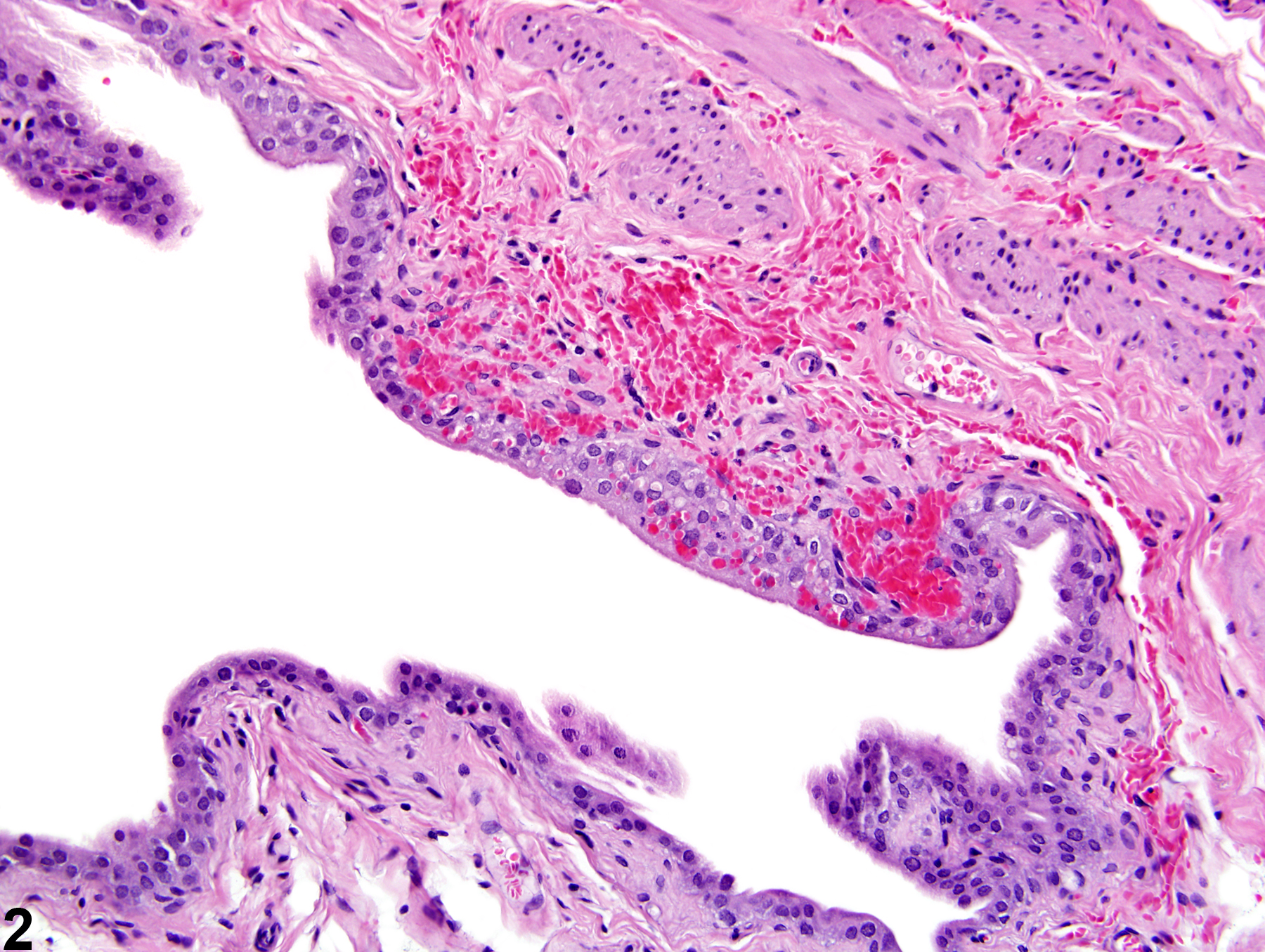 Image of hemorrhage in the urinary bladder from a male F344/N rat in a chronic study
