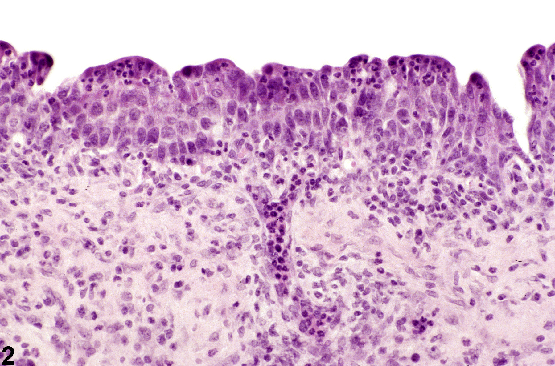 Image of inflammation in the urinary bladder from a male F344/N rat in a chronic study