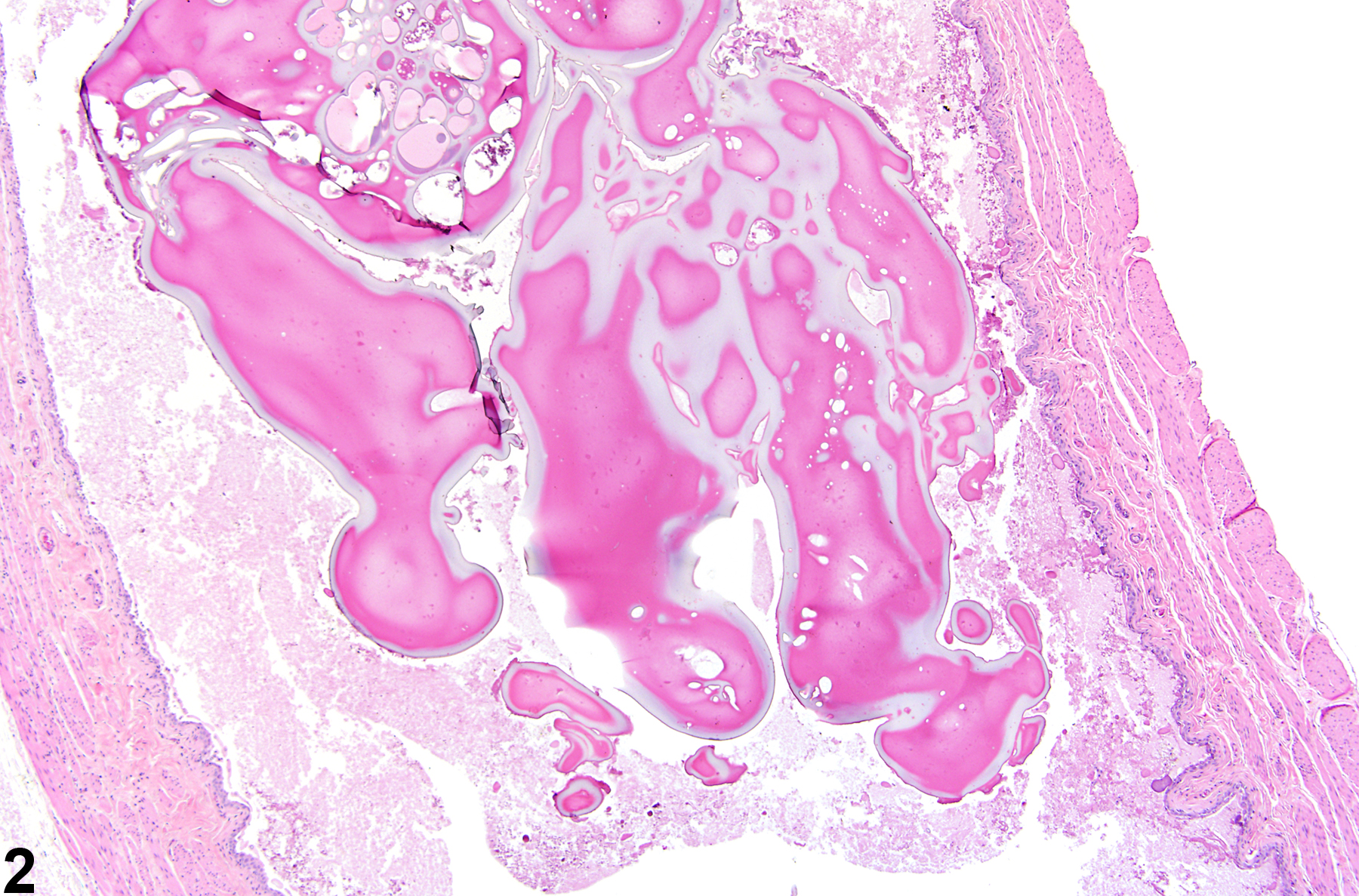 Image of proteinaceous plug in the urinary bladder from a male  F344/N rat in an acute study