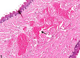 Tongue - Angiectasis - Nonneoplastic Lesion Atlas