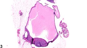 Ovary - Cyst - Nonneoplastic Lesion Atlas