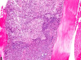 Bone marrow - Inflammation - Nonneoplastic Lesion Atlas