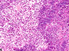Bone marrow - Inflammation - Nonneoplastic Lesion Atlas