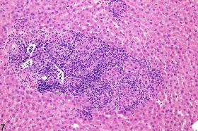 Liver - Inflammation - Nonneoplastic Lesion Atlas