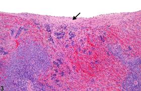 spleen - Fibrosis - Nonneoplastic Lesion Atlas