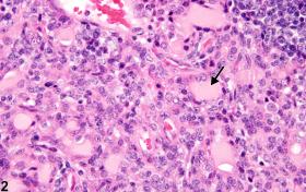 Thymus - Hyperplasia, Epithelial - Nonneoplastic Lesion Atlas