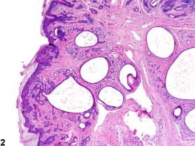 Skin - Fibroadnexal Hamartoma - Nonneoplastic Lesion Atlas