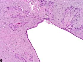 Skin - Fibroadnexal Hamartoma - Nonneoplastic Lesion Atlas