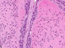 Image of acute inflammation in the coagulating gland from a male B6C3F1 mouse in a chronic study