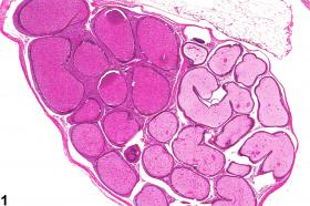 Image of sperm stasis in the epididymis from a male B6C3F1 mouse in a chronic study