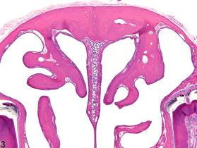 Bone - Increased Bone - Nonneoplastic Lesion Atlas