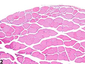 muscle atrophy histology