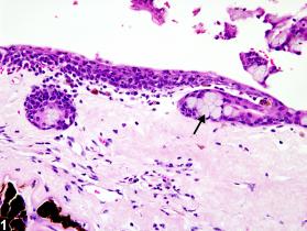 Eye, Cornea - Metaplasia, Goblet Cell - Nonneoplastic Lesion Atlas
