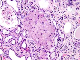 Image of renal tubule hyperplasia, oncocytic in the kidney from a male F344/N rat in a chronic study