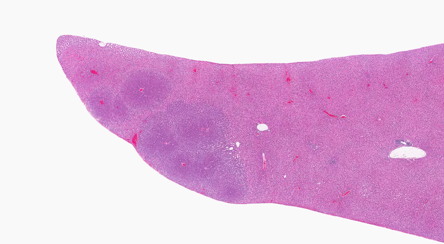 Figure 4. Representative Image of Hepatocellular Adenoma in the Liver of a Female Rat in the Perinatal and Two-year Feed Study of Tris(chloropropyl) Phosphate (H&E)