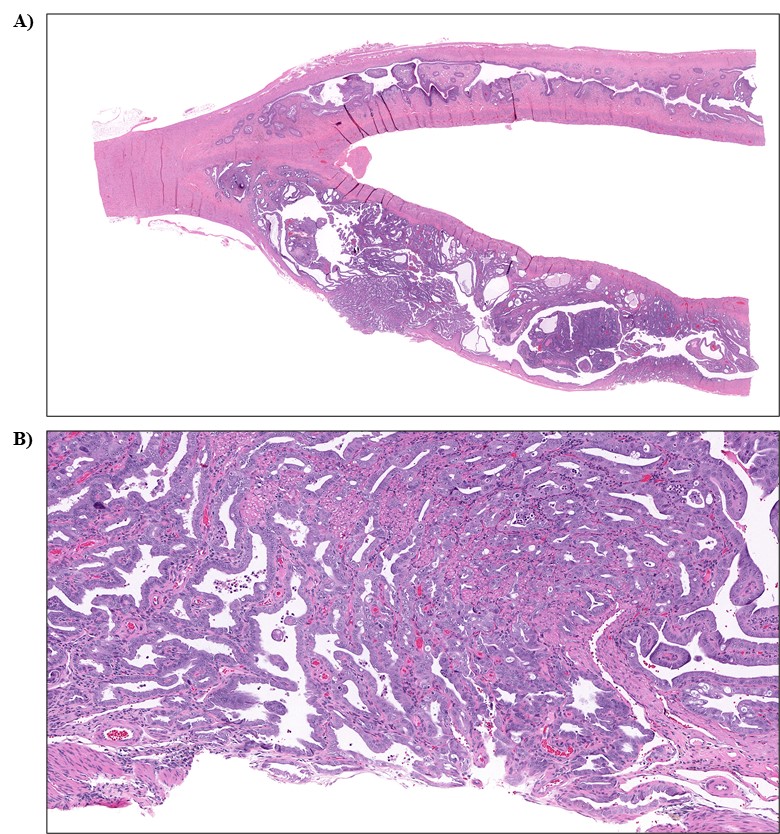 Figure 6. Representative Images of Adenocarcinoma in the Uterus of a Female Rat in the Perinatal and Two-year Feed Study of Tris(chloropropyl) Phosphate (H&E)