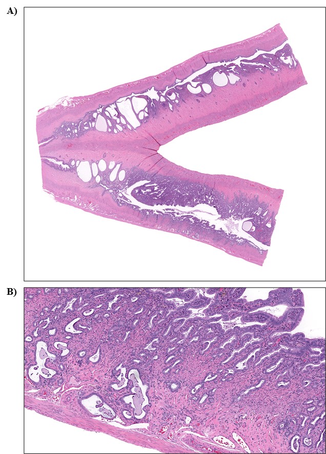 Figure 7. Representative Images of Atypical Endometrial Hyperplasia in the Uterus of a Female Rat in the Perinatal and Two-year Feed Study of Tris(chloropropyl) Phosphate (H&E)