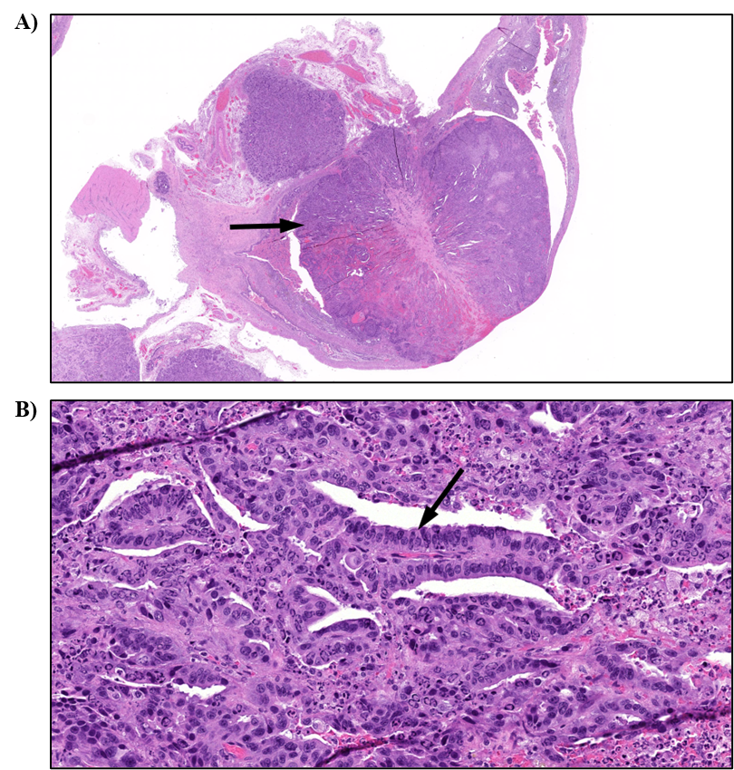Figure 5. Representative Images of Adenocarcinoma in the Uterus in a Female Rat in the Two-year Inhalation Study of α-Pinene (H&E)