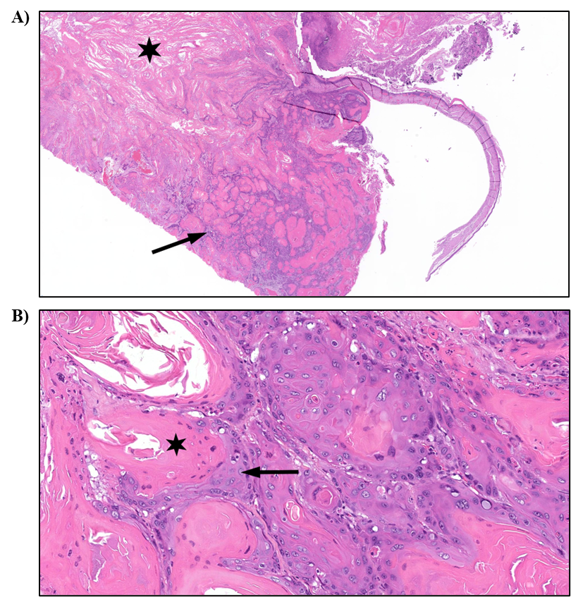 Figure 6. Representative Images of Squamous Cell Carcinoma in the Uterus in a Female Rat in the Two-year Inhalation Study of α-Pinene (H&E)