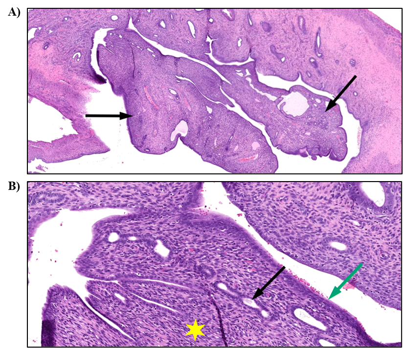 Figure 7. Representative Images of Stromal Polyp of the Uterus in a Female Rat in the Two-year Inhalation Study of α-Pinene (H&E)