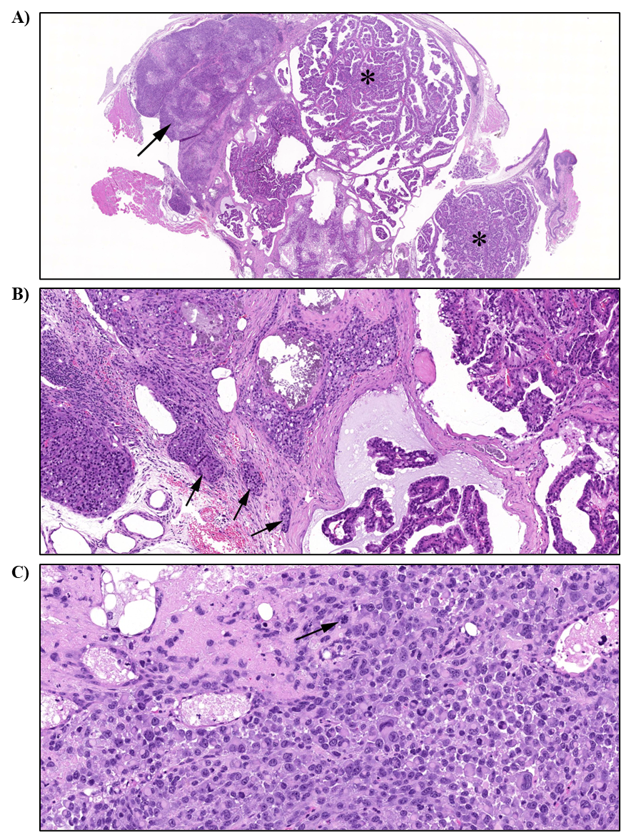 Figure 16. Representative Images of Adenocarcinoma in the Harderian Gland in Male and Female Mice in the Two-year Inhalation Study of α-Pinene (H&E)