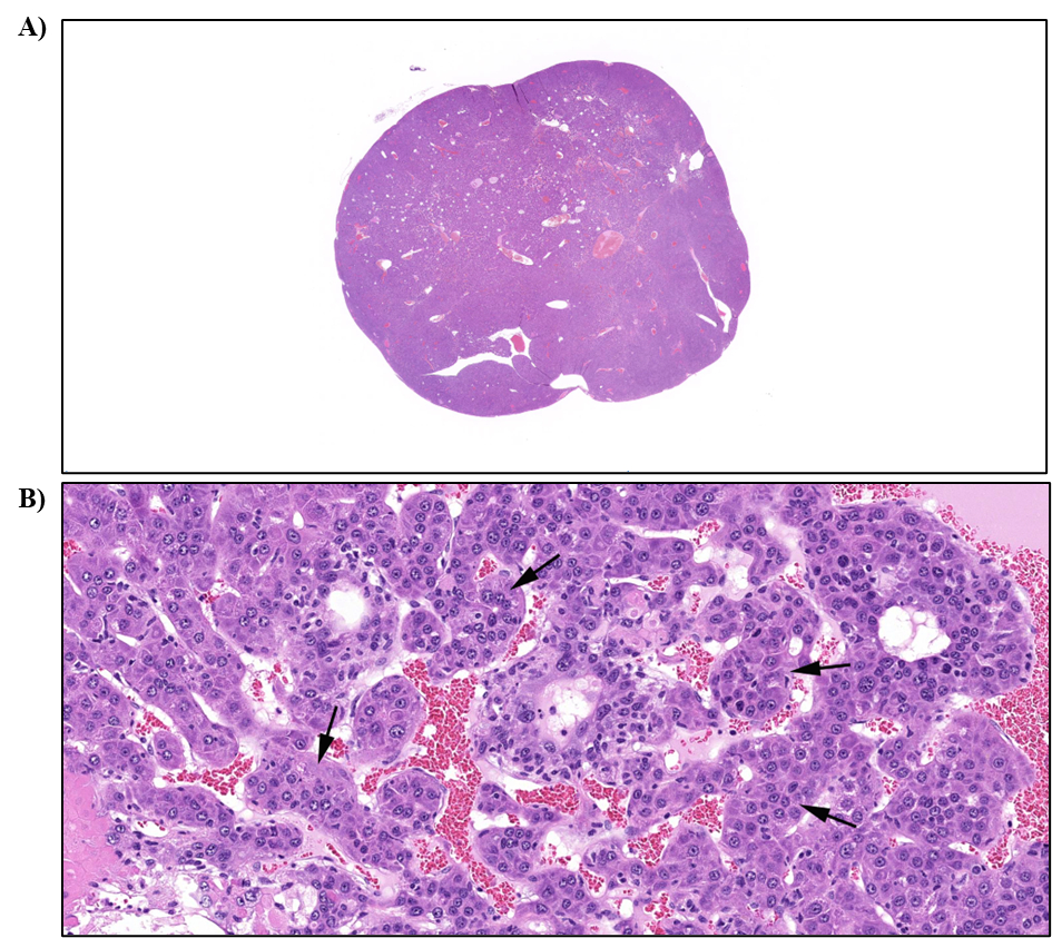 Figure 19. Representative Images of Hepatocellular Carcinoma in the Liver in a Male Mouse in the Two-year Inhalation Study of α-Pinene (H&E)