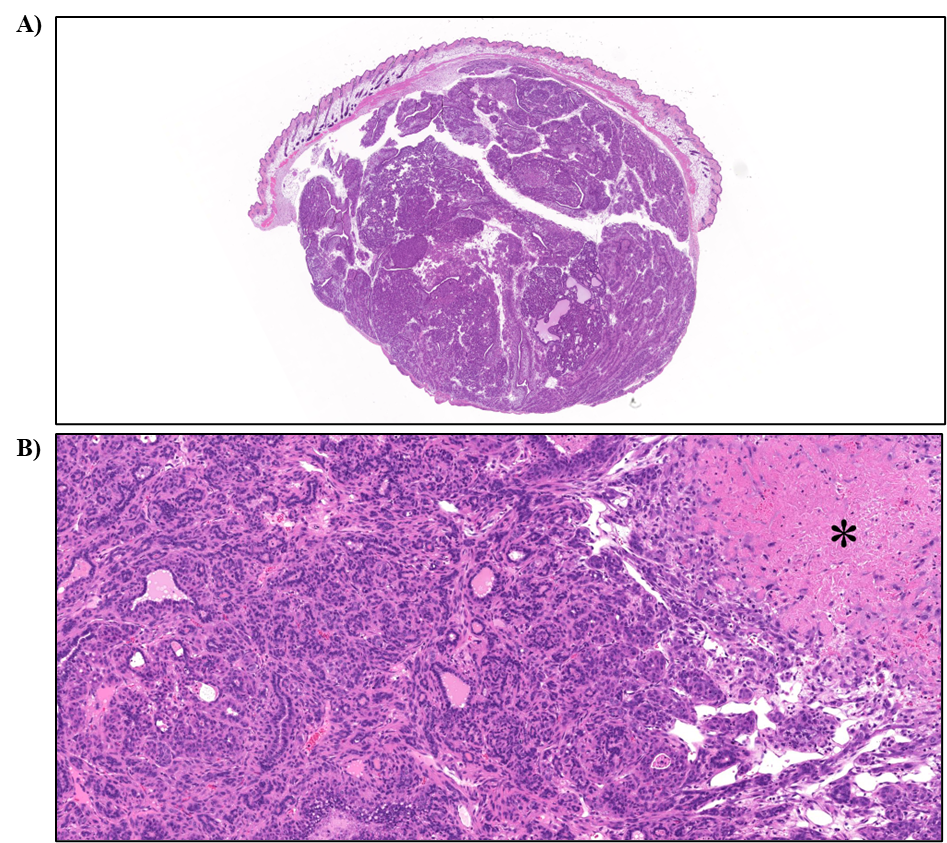 Figure 24. Representative Images of Adenocarcinoma in the Mammary Gland in Female Mice in the Two-year Inhalation Study of α-Pinene (H&E)