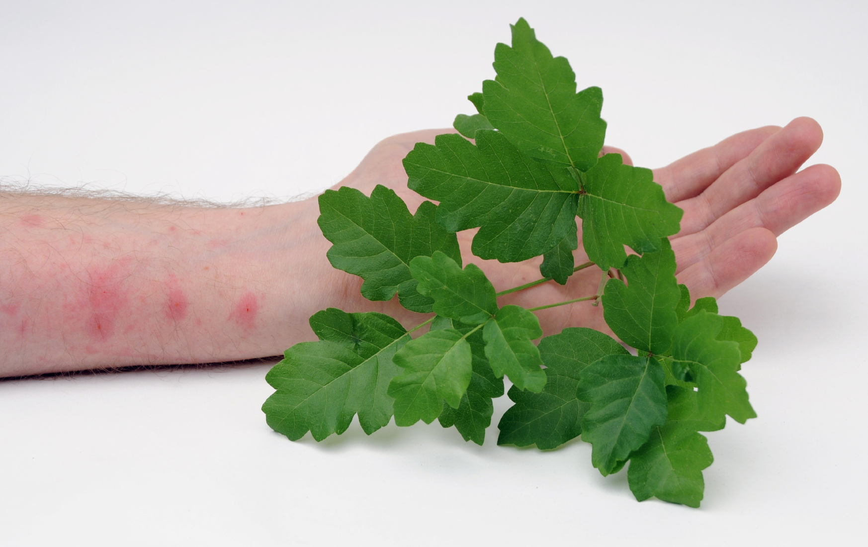 Arm with rash next to poison oak leaves.